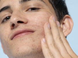 What are the main causes of Acne?