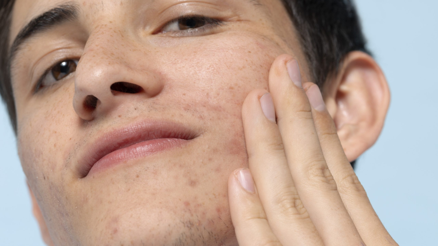 What are the main causes of Acne?