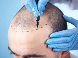 Hair Transplant London_ The TOP 10 Clinics in 2024