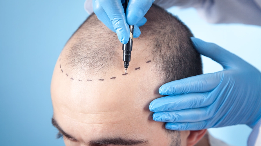 Hair Transplant London_ The TOP 10 Clinics in 2024