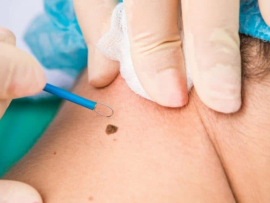 mole removal