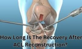 How Long Is The Recovery After ACL Reconstruction? 